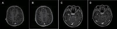 The Value of Anlotinib in the Treatment of Intractable Brain Edema: Two Case Reports